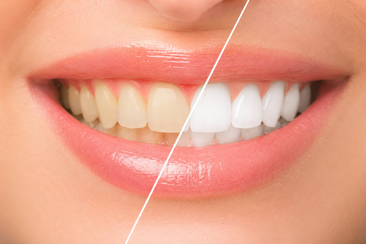 Teeth Whitening in Hanamkonda